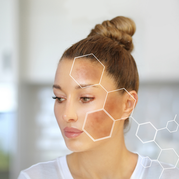 CBD i hiperpigmentacija